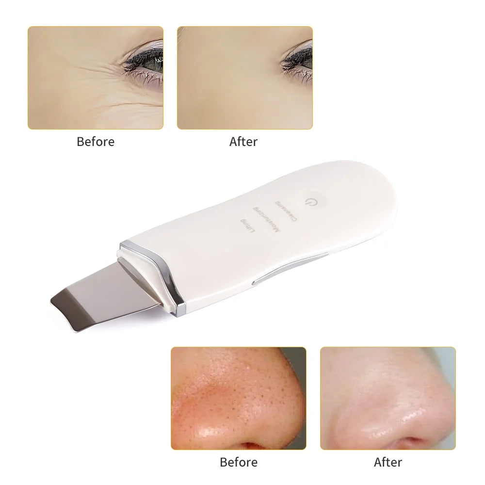 Electric Blackhead Pore Remover
